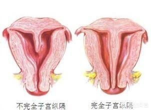 纵膈子宫是不是上不了环,纵膈子宫可以治疗吗如何进行治疗