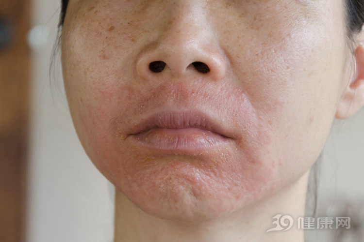 润燥止痒胶囊可以治脸上过敏吗,孕妇脸上过敏发红发痒快速止痒