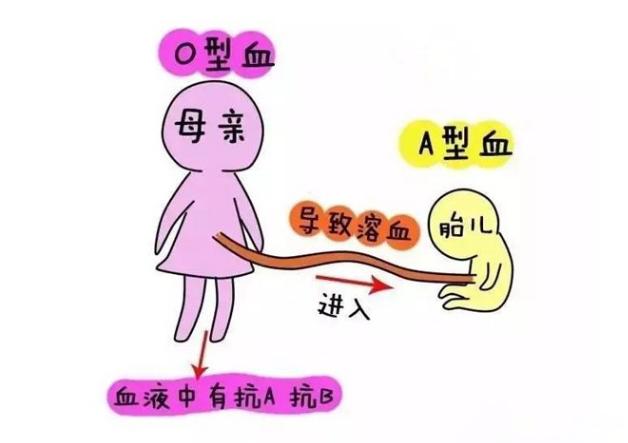 o型血的妈妈要警惕abo溶血症,abo溶血症产检时能不能查出