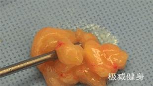 减肥抽脂的过程是怎样的,抽脂减肥的危害亲身经历