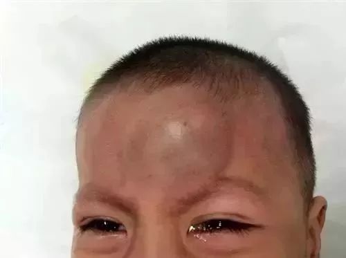儿童摔到后脑勺几天是危险期,小孩摔到后脑勺什么症状比较危险