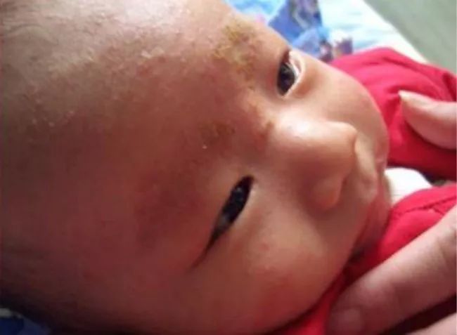 脂溢性皮炎和皮脂腺异位有关系吗,宝宝湿疹痤疮的区别