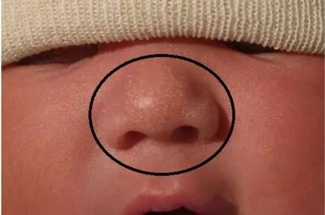 脂溢性皮炎和皮脂腺异位有关系吗,宝宝湿疹痤疮的区别