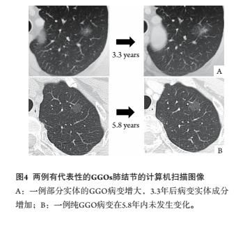 肺腺癌冷冻消融治愈的案例有吗,肺部有结节能做冷冻消融吗