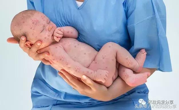 宝宝起疹的最佳治疗方法,孩子发烧后出疹怎么护理