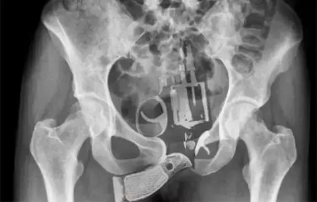 盘点X光透视下的人体异物，看着都痛！