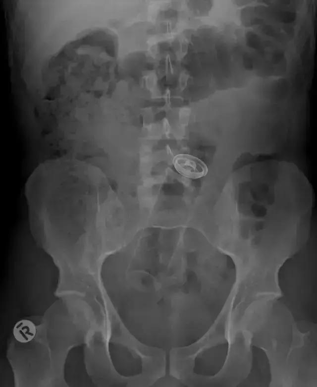 盘点X光透视下的人体异物，看着都痛！