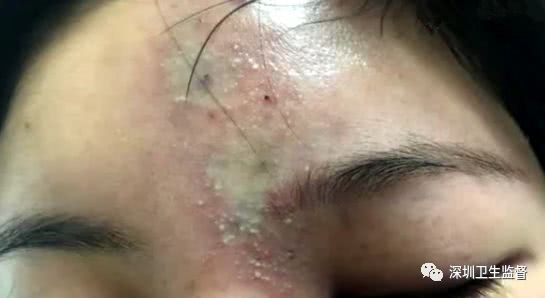 90后女子注射6针玻尿酸致残,女大学生打玻尿酸