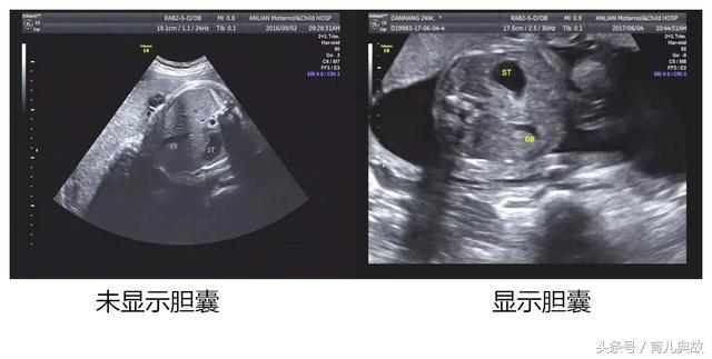 胎儿b超未见胆囊怎么进一步确诊,孕28周胎儿心脏彩超没做
