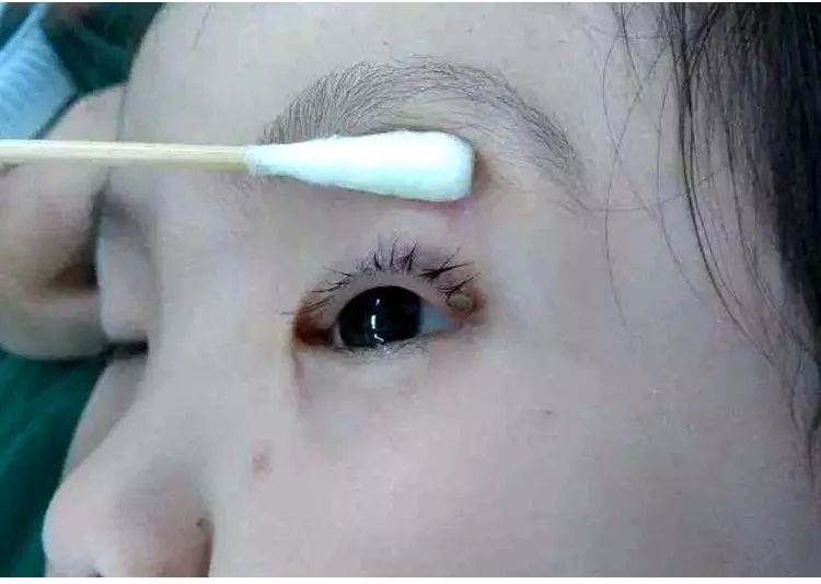 蜱虫常见的3个地方及解决技巧,蜱虫怎么预防出现在人身上