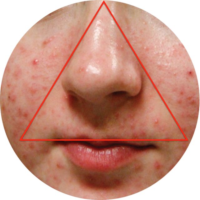 揭秘｜掰着指头数数被痘痘骚扰了多少年？弘叔帮你终止在今年夏天！（上）