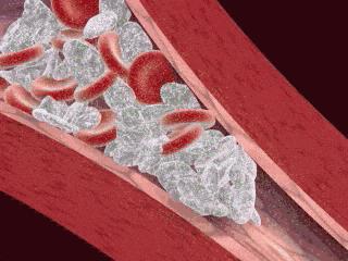 血管干净的十个好方法,你的血管健康么