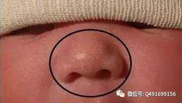 新生儿常见的生理反射有哪些,新生儿特殊生理现象照片