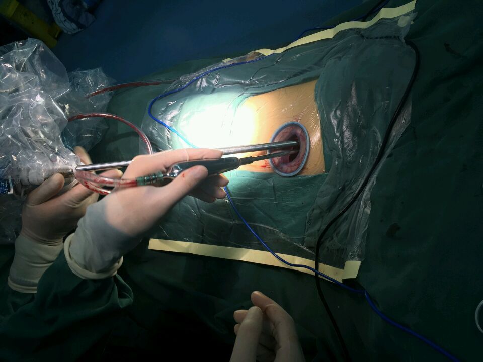 单孔胸腔镜肺癌根治手术获得成功,胸腔镜下肺组织或病灶切除术