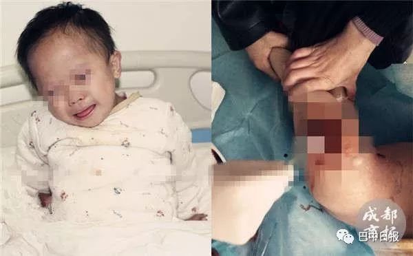还记得患重病左腿3个大窟窿的通江男童吗？有他的最新消息了！