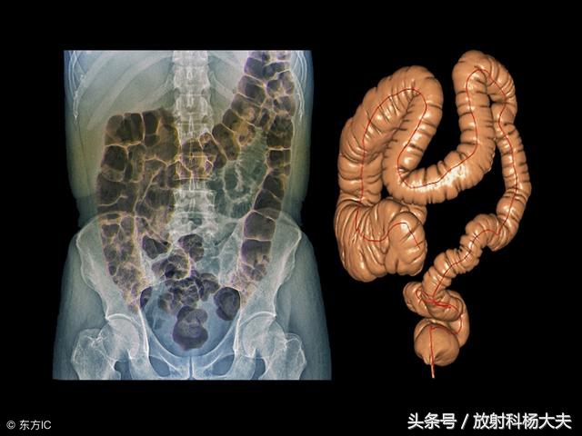 结直肠癌早期筛查还用做肠镜吗,用ct可以看清直肠息肉吗