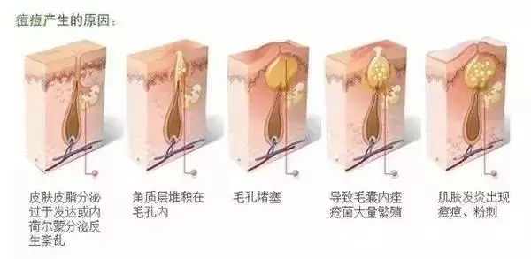 欧阳娜娜推荐去痘印,欧阳娜娜推荐的祛痘膏叫什么名字