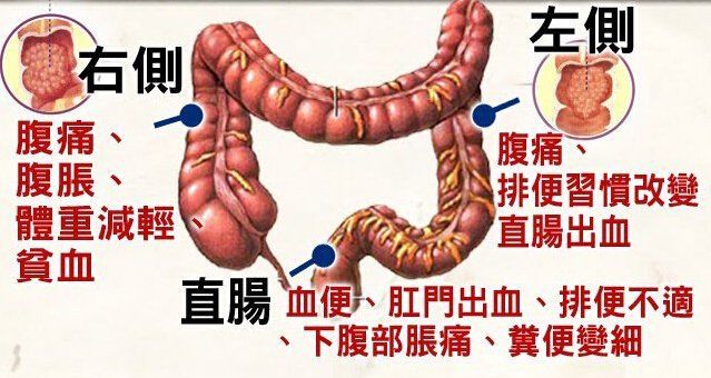 大肠癌会传染给家人吗,大肠癌是如何传染的