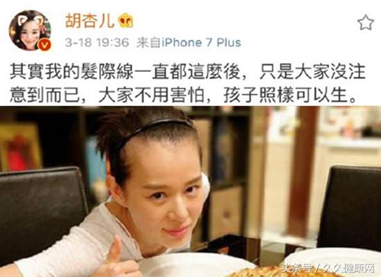 宝妈发际线后移脱发,胡杏儿谈产后恢复