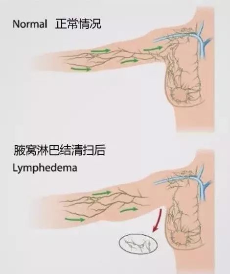乳腺癌术后上肢出现肿胀怎么处理,乳腺癌术后出现患肢肿胀如何处理