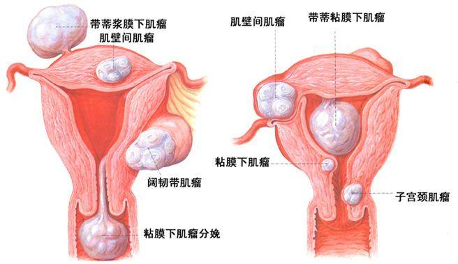 子宫肌瘤最怕的三个食物,子宫肌瘤最怕四种食物