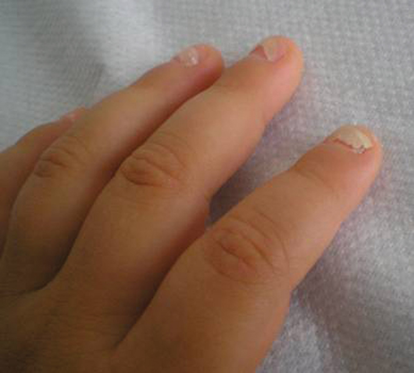 孩子手指甲上有白点是缺什么,1岁宝宝指甲白点是缺什么