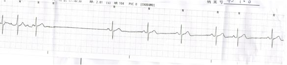 房颤伴窦性停搏怎么治,李广平心脏起搏视频