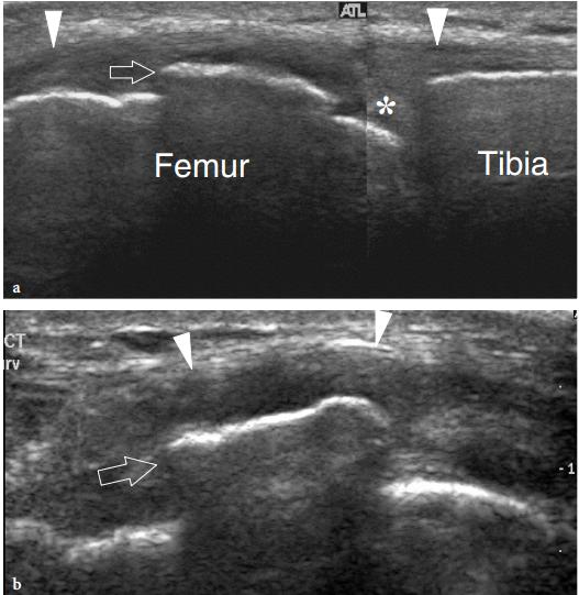 膝关节疼怎么诊断是关节炎,膝关节内翻诊断标准