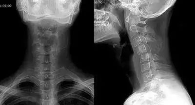 脊柱生理曲度变直的原因,脊柱生理曲度变直为什么还是驼背