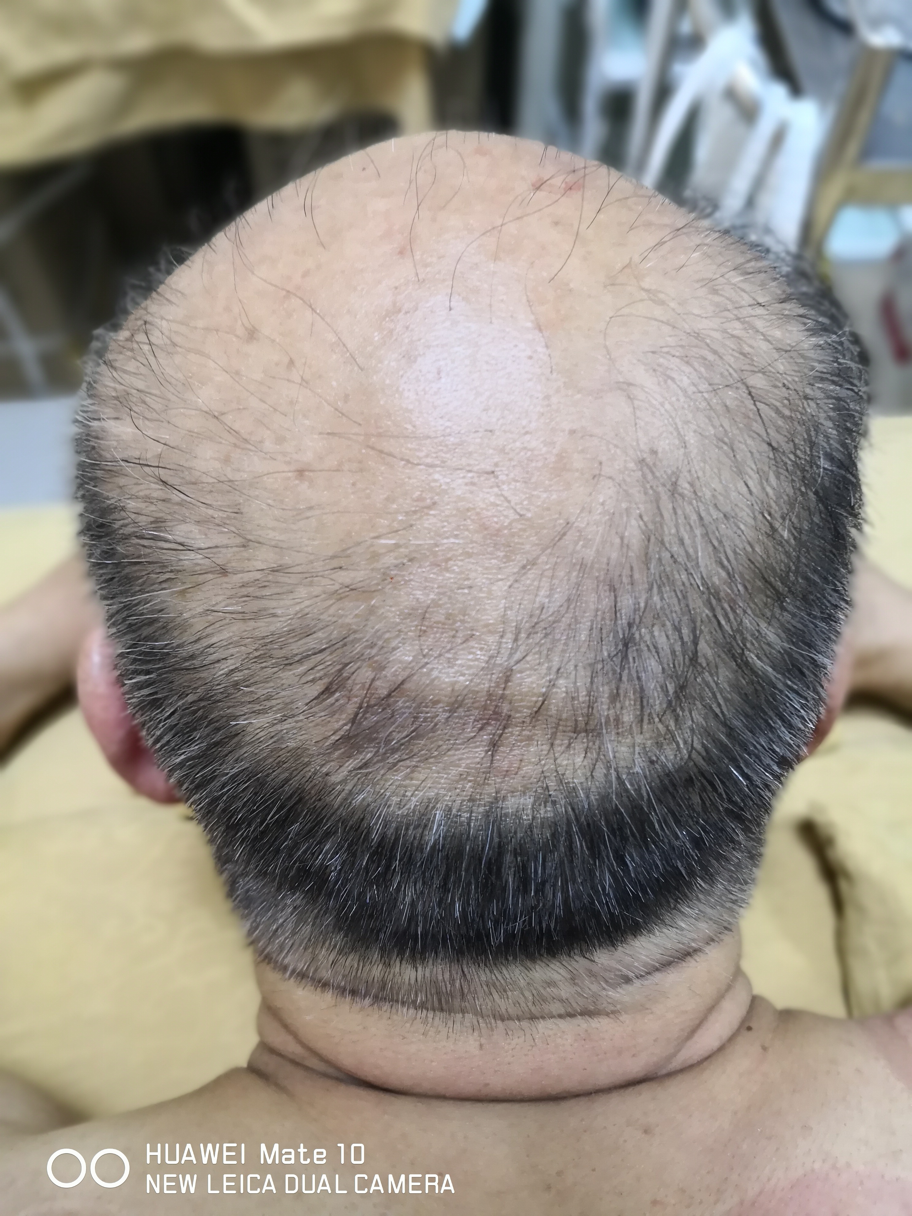 股骨头坏死二期置换好吗,遗传型脱发白发