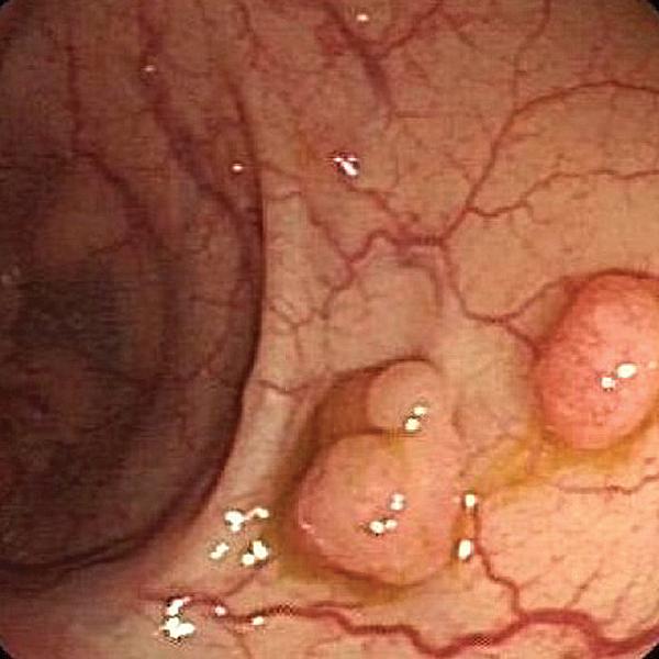 嘴唇上有黑斑是有癌症了吗,嘴唇有黑斑是肠道有病吗