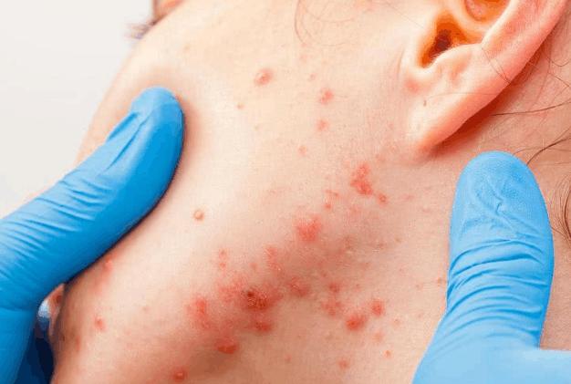 下巴长小脓包型痘痘怎么快速消除,下巴爱长痘有什么方法调理吗