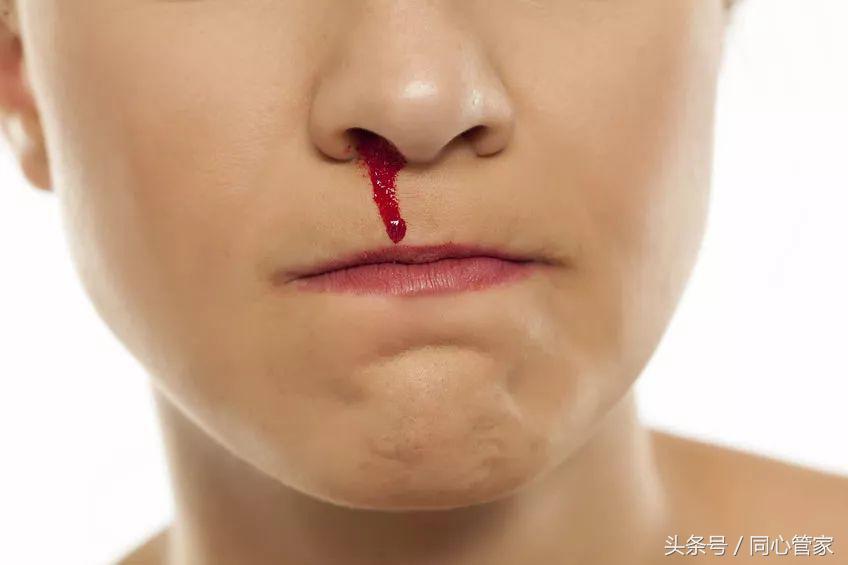 支架术后吃药轻微流鼻血,支架后流鼻血怎么办