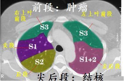 ct诊断肺癌肺结核,ct诊断出肺结核准确率高吗