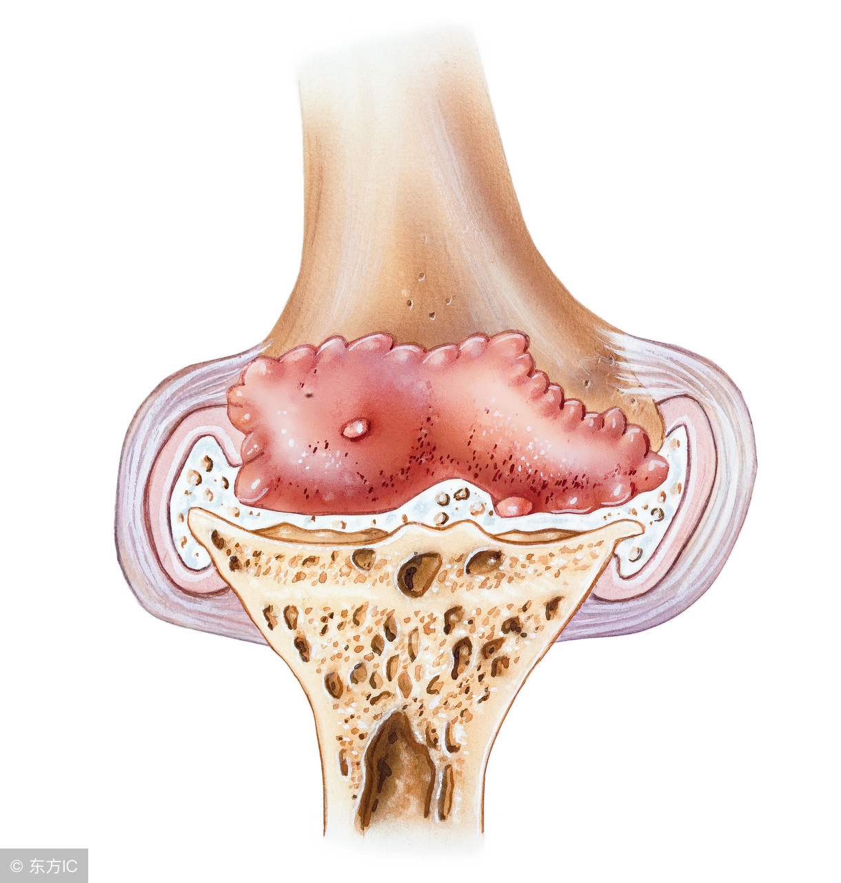 膝关节长骨刺最佳的治疗方法,如何治疗膝关节长骨刺