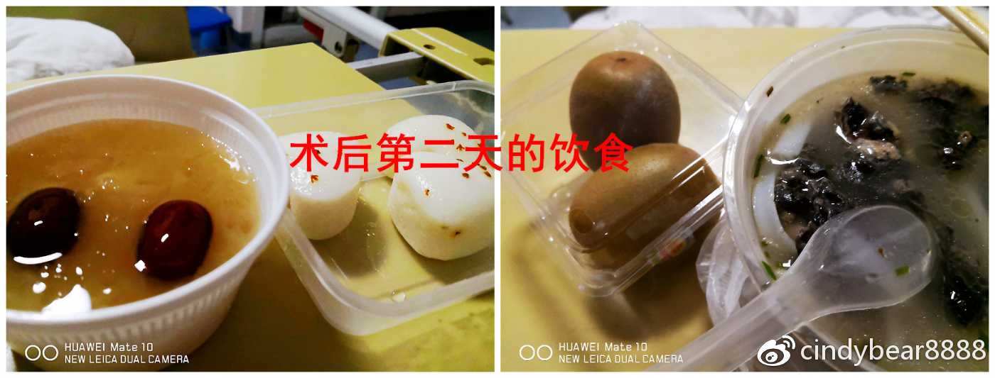 动画演示子宫全切术,动画演示切子宫手术