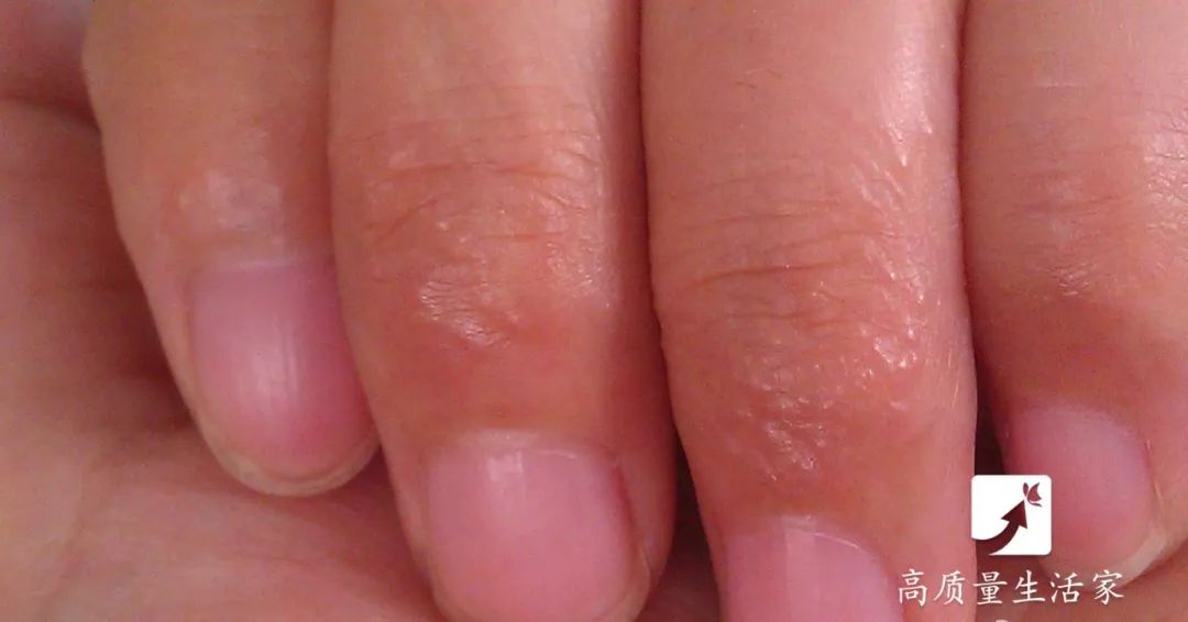 手上长水泡非常痒别抓这样处理,手上起小水泡很痒有什么土方法