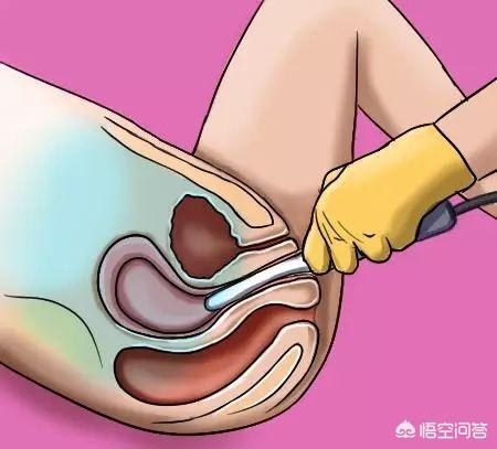 妇科检查卵巢多囊样改变啥意思,卵巢多囊样改变阴超报告
