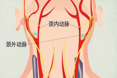科普预防颈动脉狭窄的四种方法,颈动脉中度狭窄的治疗方法是
