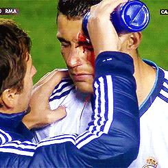 c罗被打满脸是血是哪一次,眼角被撞出血了一定要缝针么