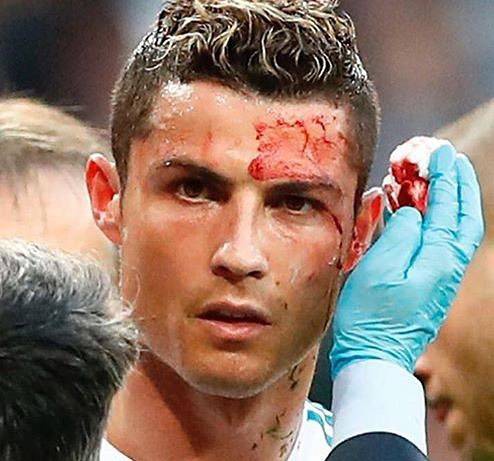 c罗被打满脸是血是哪一次,眼角被撞出血了一定要缝针么