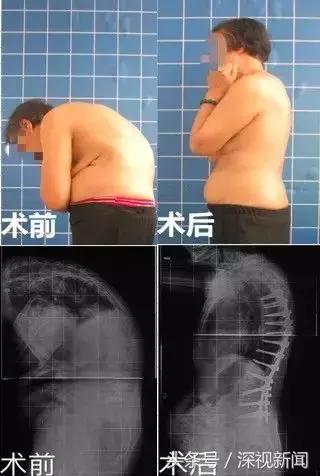 国家青少年脊柱侧弯免费救助文件,脊柱侧弯可以领多少补助