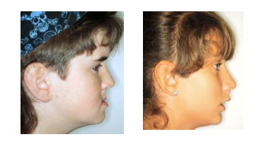 暑期孩子想矫正牙齿？北京口腔医院专家来解答这10个问题