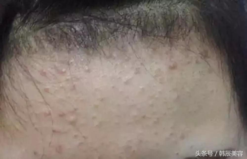 防止脸上长粉刺的方法,脸上长斑要当心