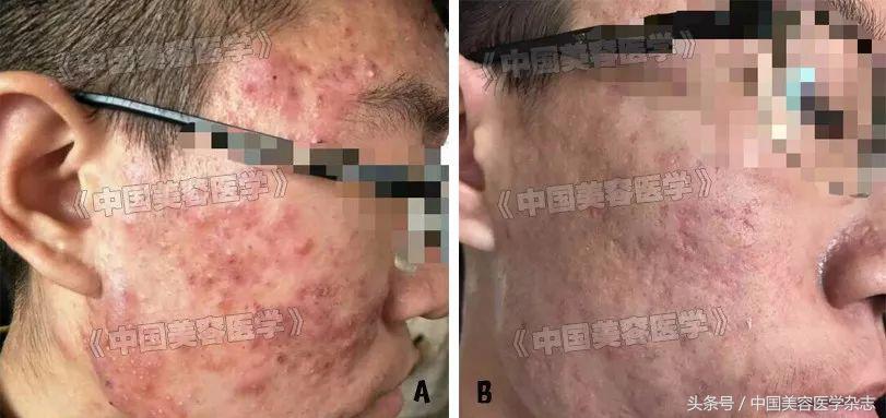 严重痤疮对人的心理的影响,严重痤疮会有哪些病症