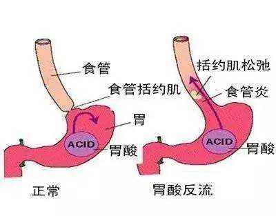 胃酸，反酸，胃胀该怎么吃饭？关注什么？