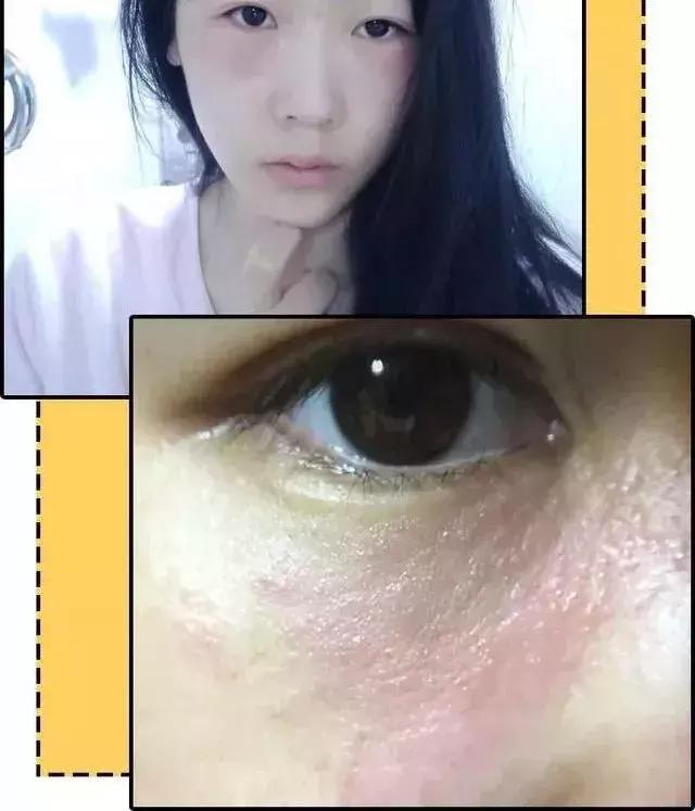 可怕！她把痔疮膏当眼霜涂了以后……差点儿毁容了！