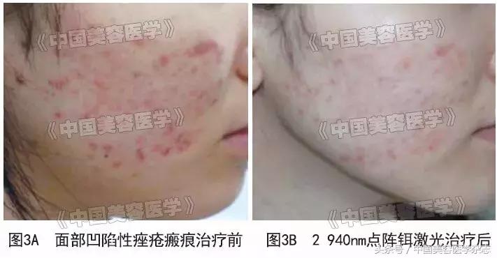 点阵激光治疗疤痕的原理,点阵激光治疗疤痕对比图
