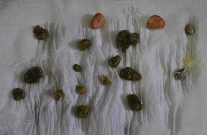 输尿管结石10x5mm要做手术吗,输尿管结石保守治疗方法有哪些