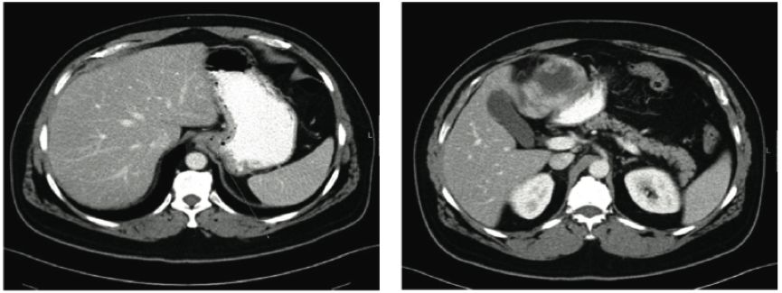 pubmed文献总结,pubmed文献综述类